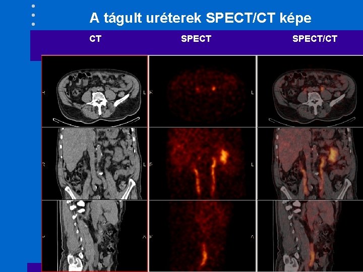 A tágult uréterek SPECT/CT képe CT SPECT/CT 