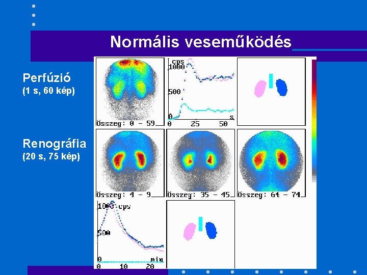 Normális veseműködés Perfúzió (1 s, 60 kép) Renográfia (20 s, 75 kép) 