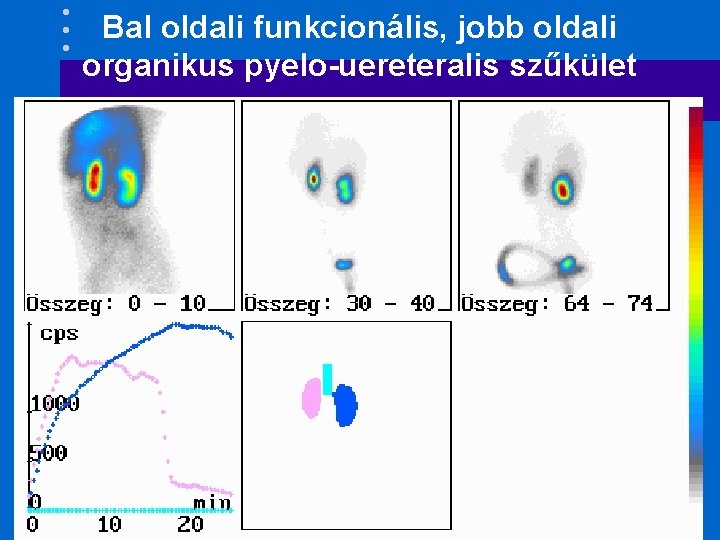 Bal oldali funkcionális, jobb oldali organikus pyelo-uereteralis szűkület 