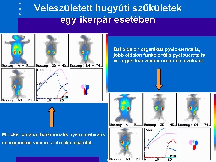 Veleszületett hugyúti szűkületek egy ikerpár esetében Bal oldalon organikus pyelo-ueretalis, jobb oldalon funkcionális pyeloueretalis