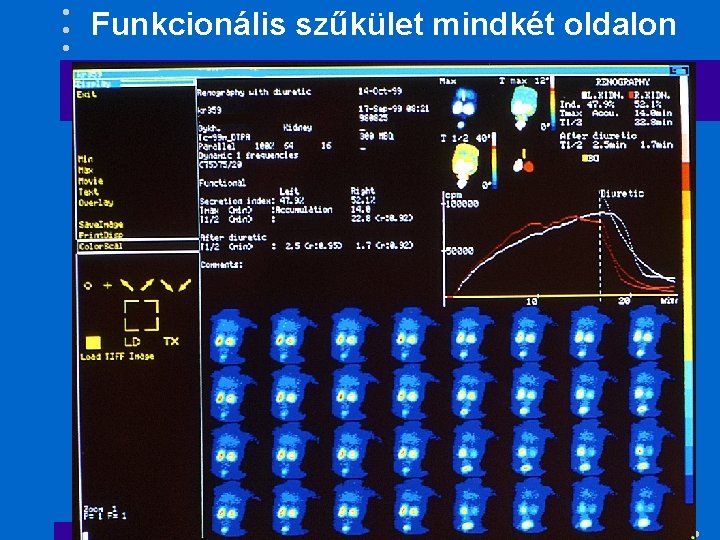 Funkcionális szűkület mindkét oldalon 