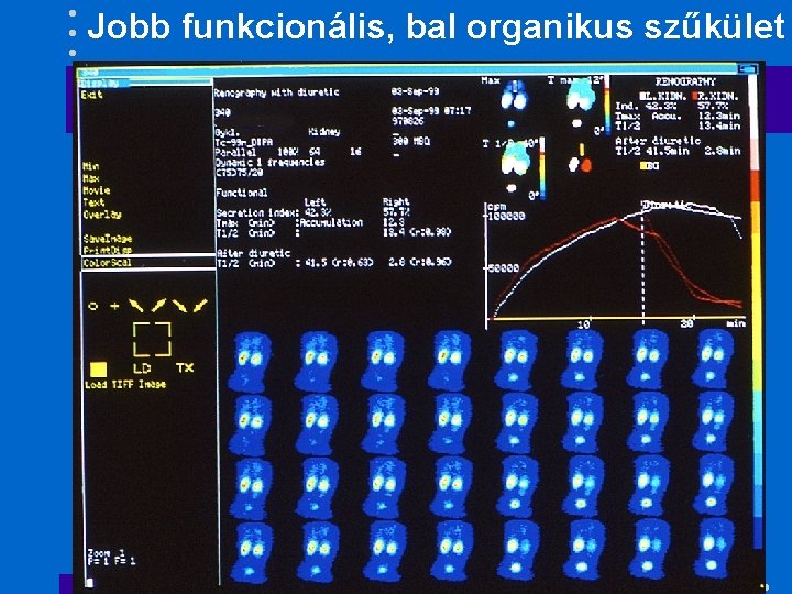 Jobb funkcionális, bal organikus szűkület 