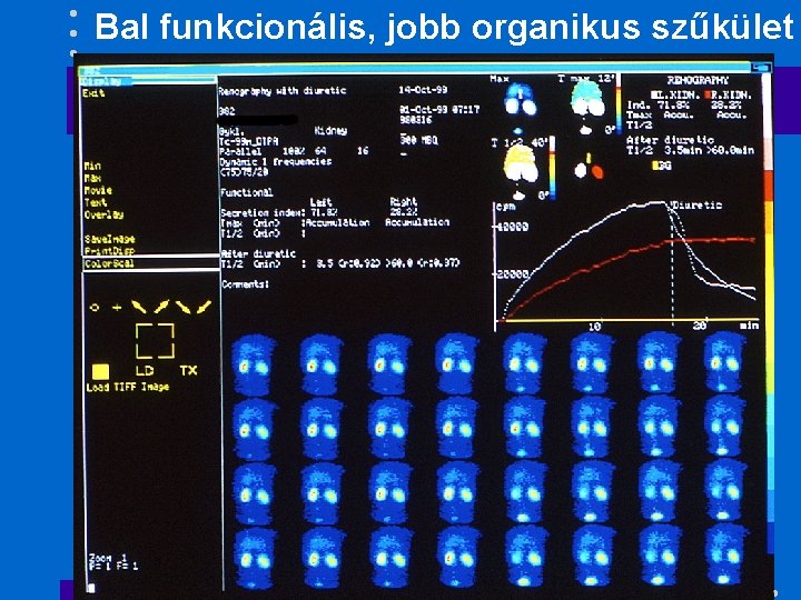 Bal funkcionális, jobb organikus szűkület 