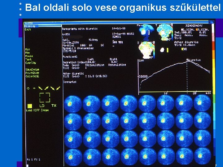 Bal oldali solo vese organikus szűkülettel 