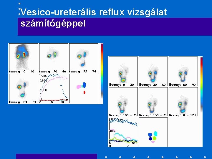 Vesico-ureterális reflux vizsgálat számítógéppel 