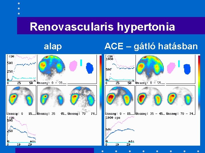 Renovascularis hypertonia alap ACE – gátló hatásban 