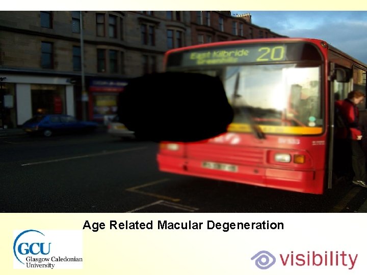 Bus macular degeneration Age Related Macular Degeneration 