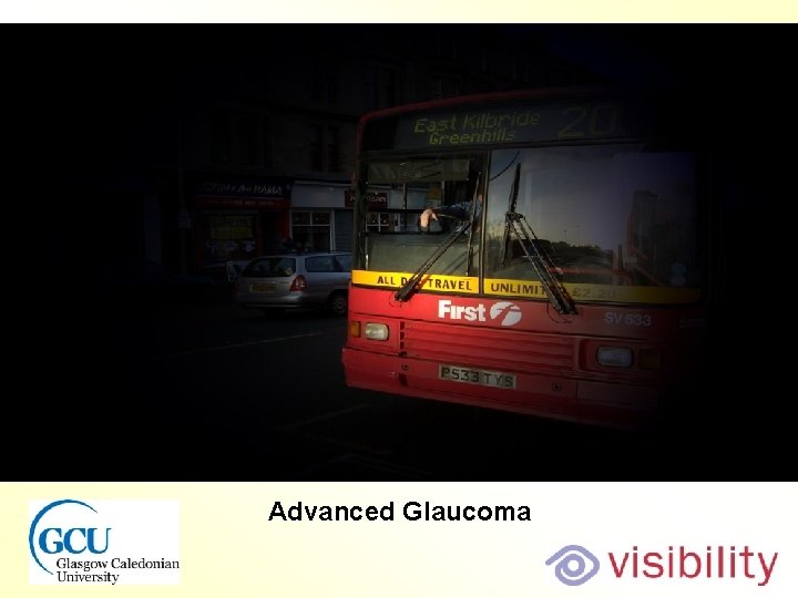 Bus glaucoma Advanced Glaucoma 