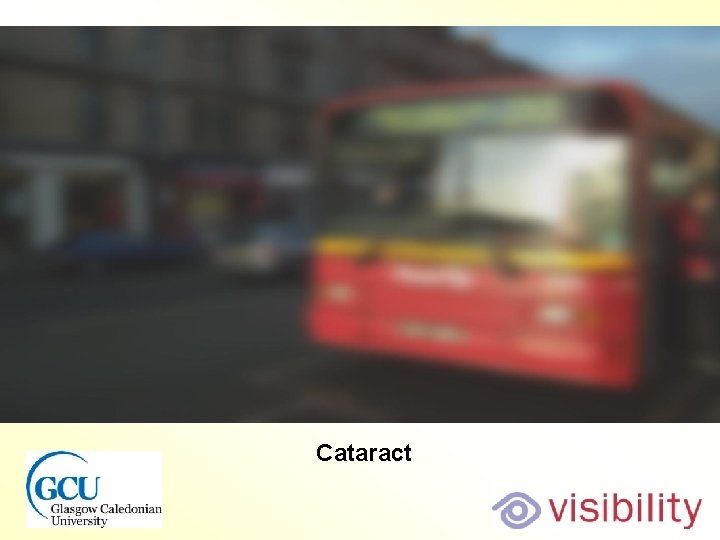 Bus cataract Cataract 