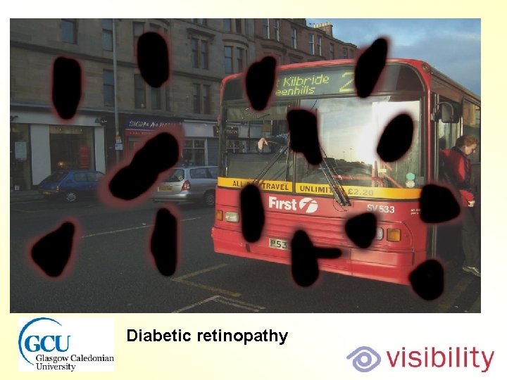 Bus diabetic retinopathy Diabetic retinopathy 