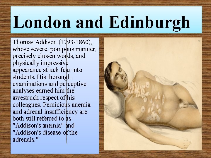 London and Edinburgh Thomas Addison (1793 -1860), whose severe, pompous manner, precisely chosen words,