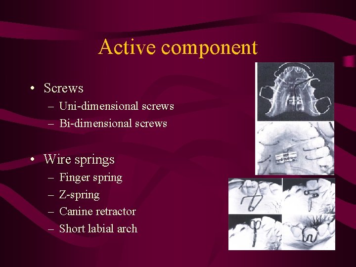 Active component • Screws – Uni-dimensional screws – Bi-dimensional screws • Wire springs –