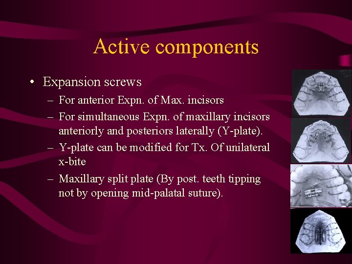 Active components • Expansion screws – For anterior Expn. of Max. incisors – For