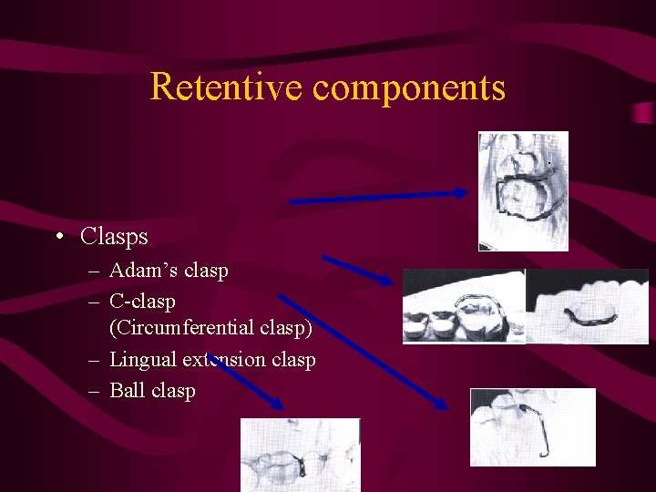 Retentive components • Clasps – Adam’s clasp – C-clasp (Circumferential clasp) – Lingual extension
