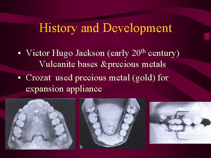 History and Development • Victor Hugo Jackson (early 20 th century) Vulcanite bases &precious