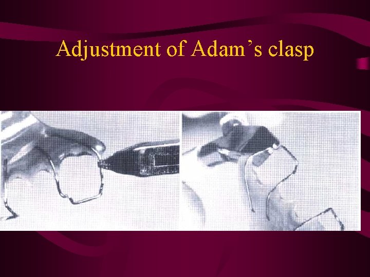 Adjustment of Adam’s clasp 