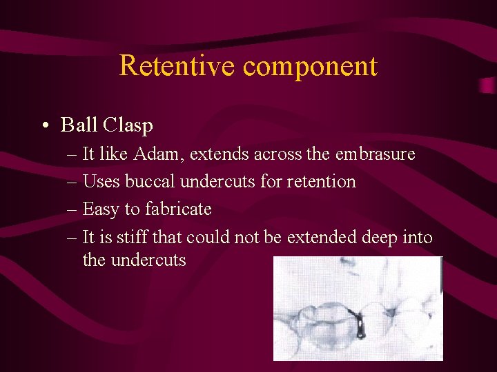 Retentive component • Ball Clasp – It like Adam, extends across the embrasure –