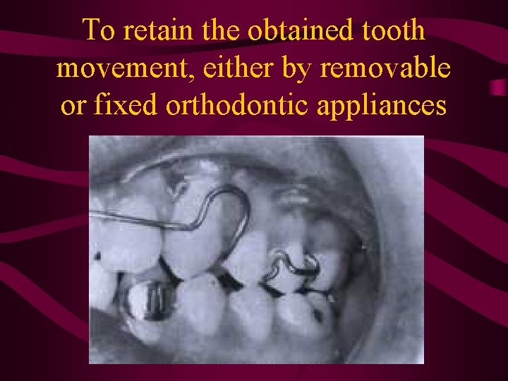 To retain the obtained tooth movement, either by removable or fixed orthodontic appliances 