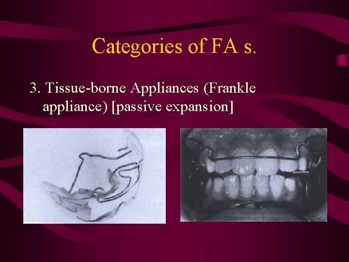 Categories of FA s. 3. Tissue-borne Appliances (Frankle appliance) [passive expansion] 