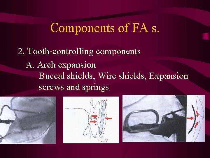 Components of FA s. 2. Tooth-controlling components A. Arch expansion Buccal shields, Wire shields,