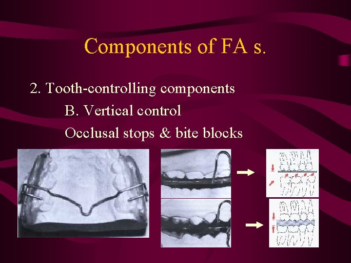 Components of FA s. 2. Tooth-controlling components B. Vertical control Occlusal stops & bite