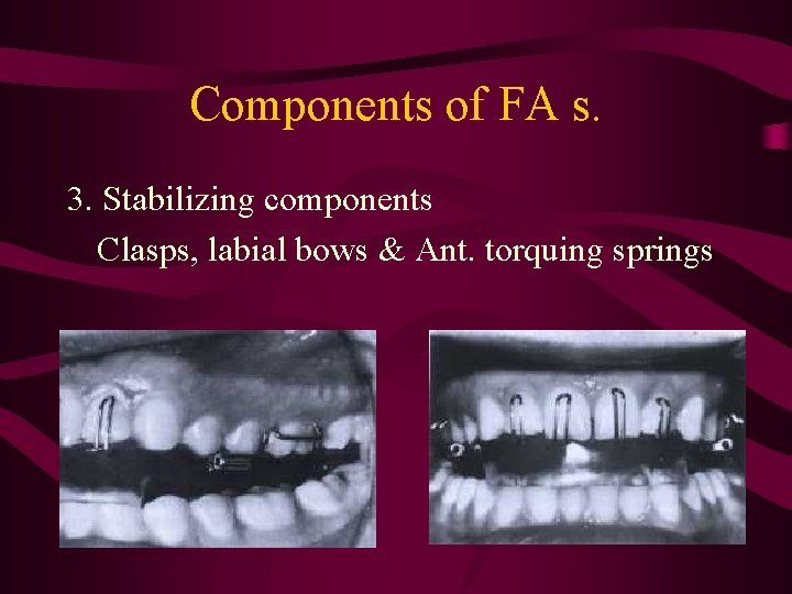 Components of FA s. 3. Stabilizing components Clasps, labial bows & Ant. torquing springs