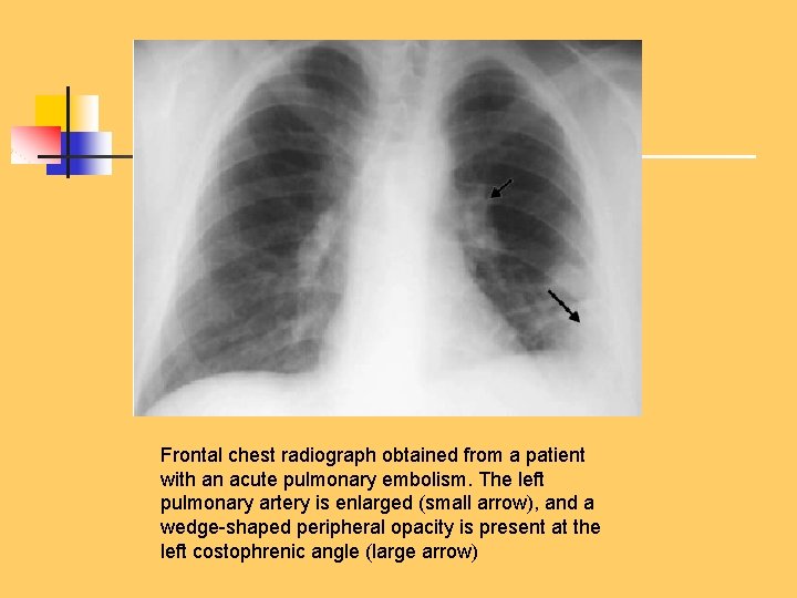 Frontal chest radiograph obtained from a patient with an acute pulmonary embolism. The left