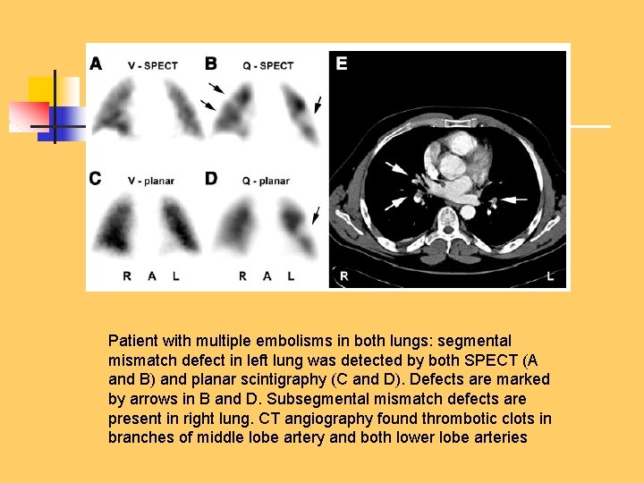 Patient with multiple embolisms in both lungs: segmental mismatch defect in left lung was