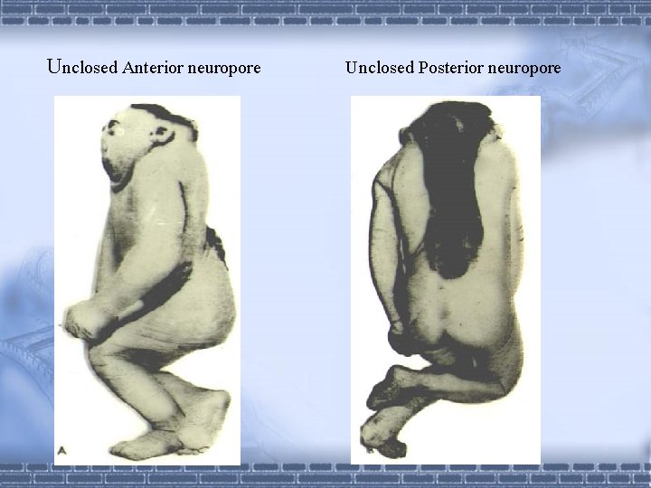 Unclosed Anterior neuropore Unclosed Posterior neuropore 