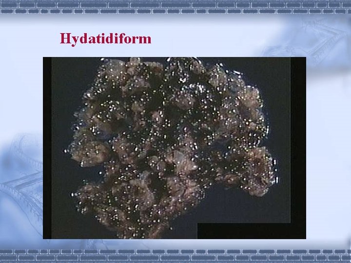 Hydatidiform 