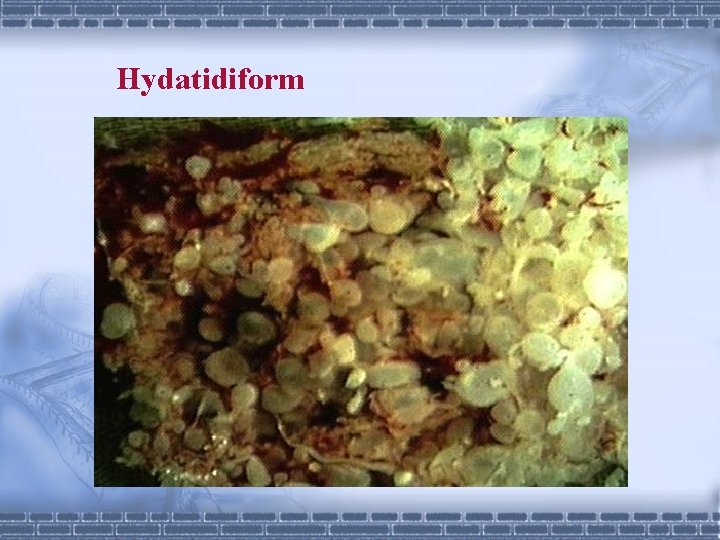 Hydatidiform 