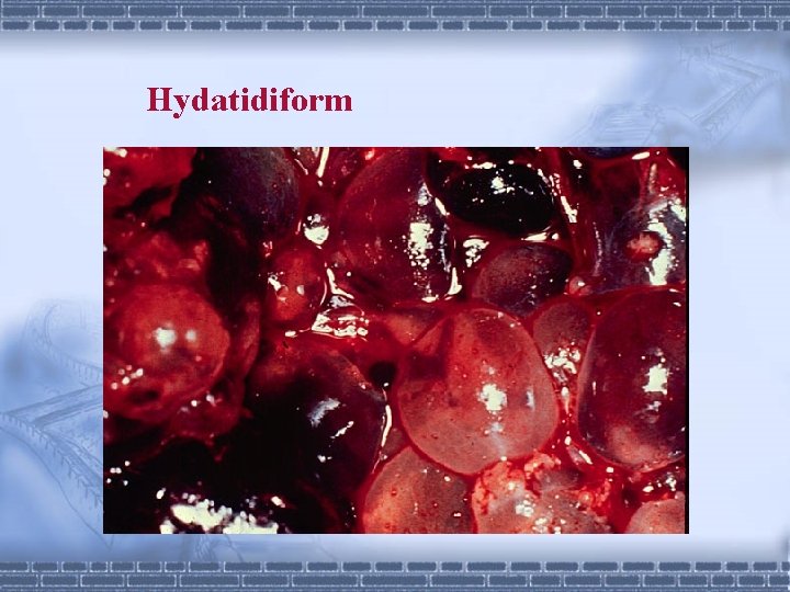 Hydatidiform 