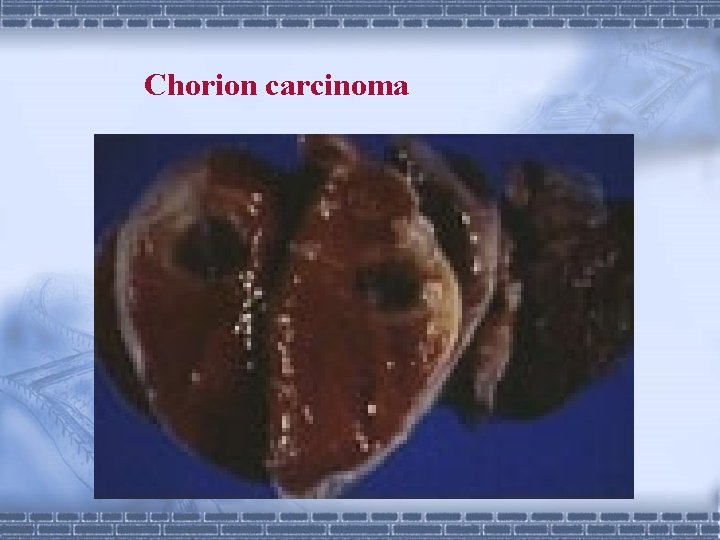 Chorion carcinoma 