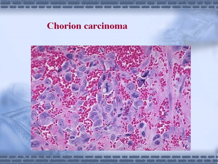 Chorion carcinoma 