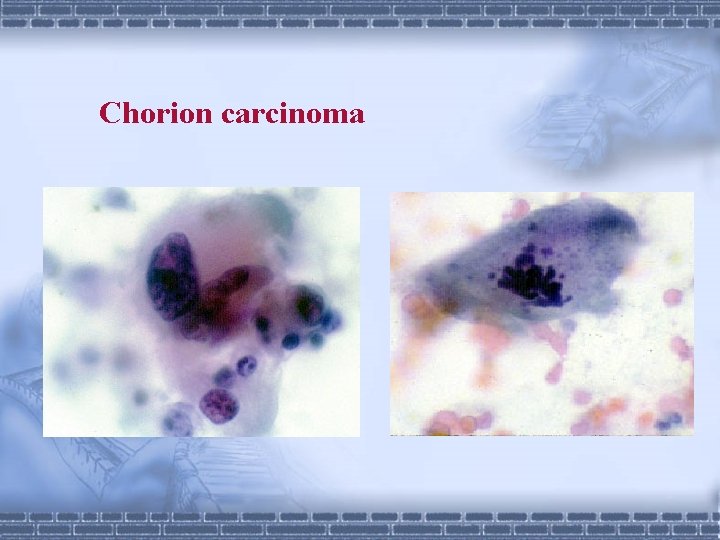 Chorion carcinoma 