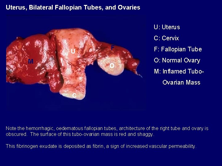 Uterus, Bilateral Fallopian Tubes, and Ovaries U: Uterus C: Cervix U M F O