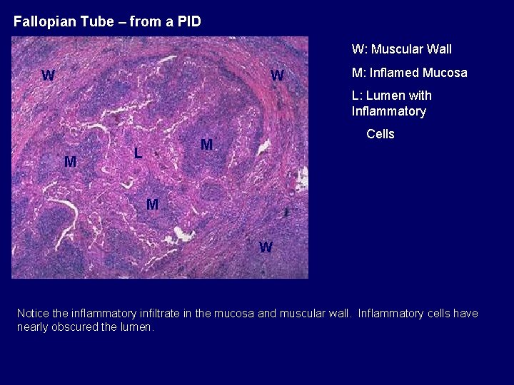 Fallopian Tube – from a PID W: Muscular Wall W W M: Inflamed Mucosa