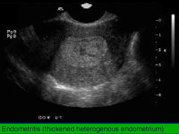 Endometritis (thickened heterogenous endometrium) 
