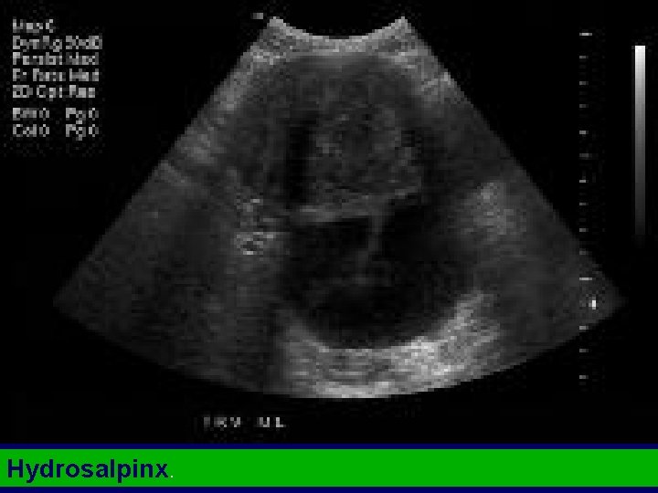 Hydrosalpinx. 