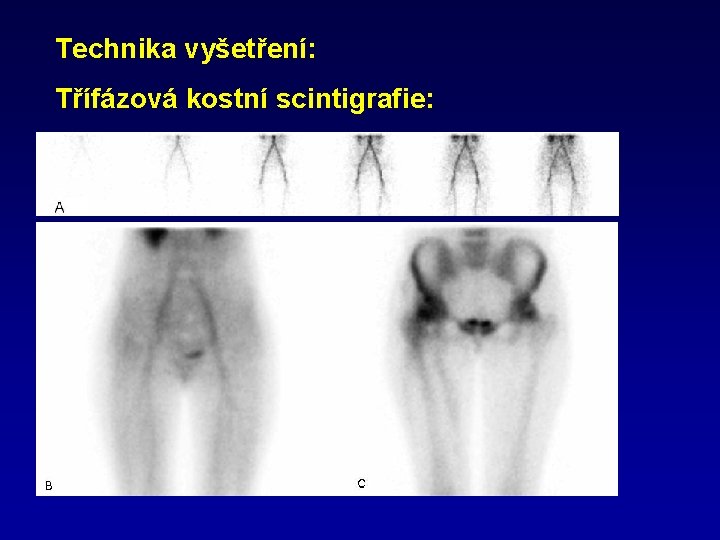 Technika vyšetření: Třífázová kostní scintigrafie: 