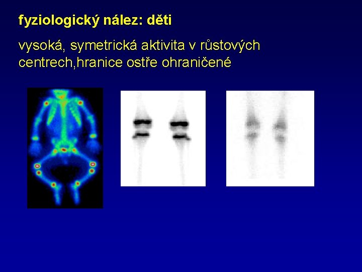 fyziologický nález: děti vysoká, symetrická aktivita v růstových centrech, hranice ostře ohraničené 