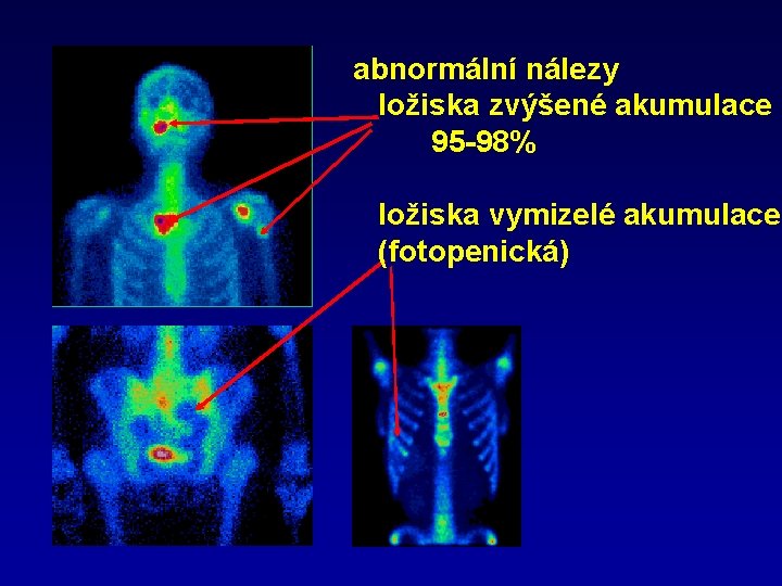 abnormální nálezy ložiska zvýšené akumulace 95 -98% ložiska vymizelé akumulace (fotopenická) 