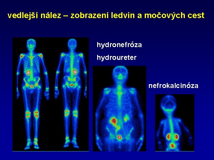 vedlejší nález – zobrazení ledvin a močových cest hydronefróza hydroureter nefrokalcinóza 