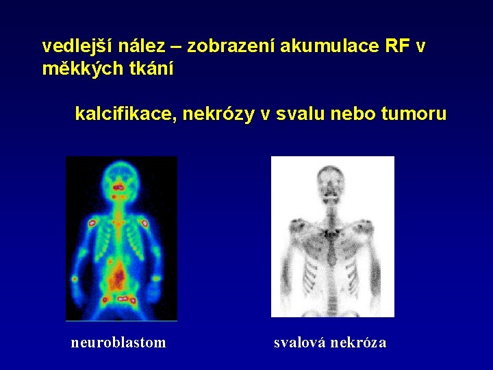 vedlejší nález – zobrazení akumulace RF v měkkých tkání kalcifikace, nekrózy v svalu nebo