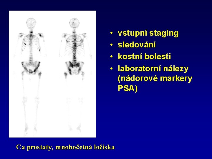  • • Ca prostaty, mnohočetná ložiska vstupní staging sledování kostní bolesti laboratorní nálezy