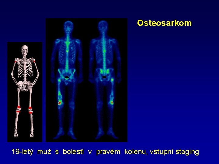 Osteosarkom 19 -letý muž s bolestí v pravém kolenu, vstupní staging 