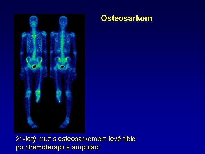 Osteosarkom 21 -letý muž s osteosarkomem levé tibie po chemoterapii a amputaci 