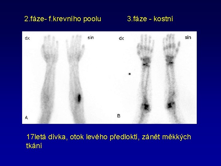 2. fáze- f. krevního poolu 3. fáze - kostní 17 letá dívka, otok levého