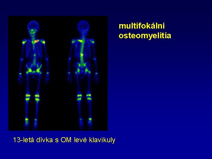 multifokální osteomyelitia 13 -letá dívka s OM levé klavikuly 