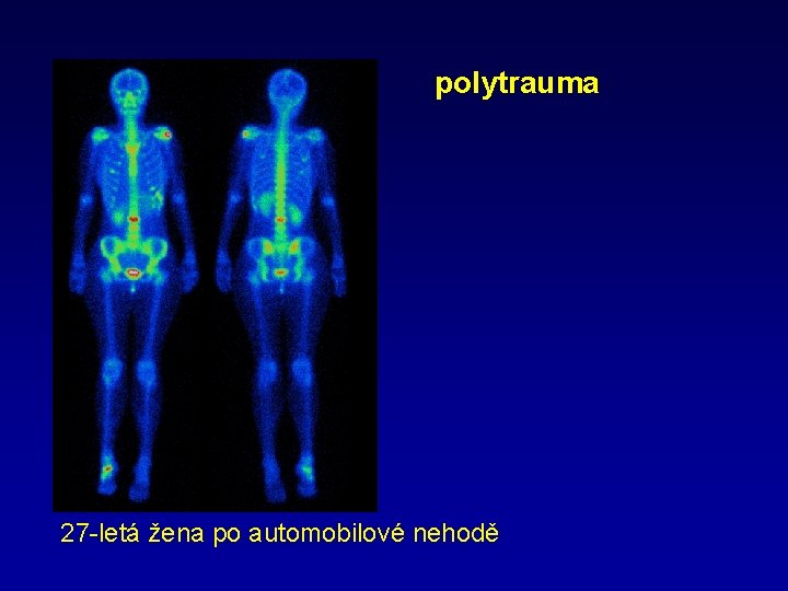 polytrauma 27 -letá žena po automobilové nehodě 